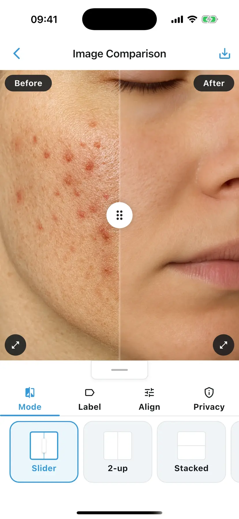 PixioDoc before-and-after comparison screen showing progress slider between two visits